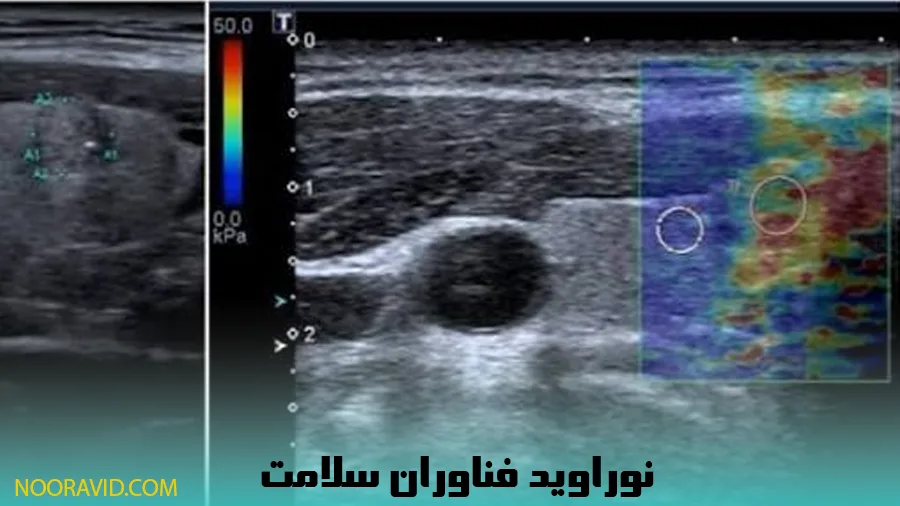 نقشه رنگی الاستوگرافی SWE دستگاه Aixplorer برای تشخیص سفتی بافت